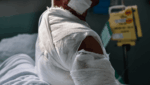 Burn injury victim with severe arm and shoulder burns wrapped in bandages in a Texas hospital.