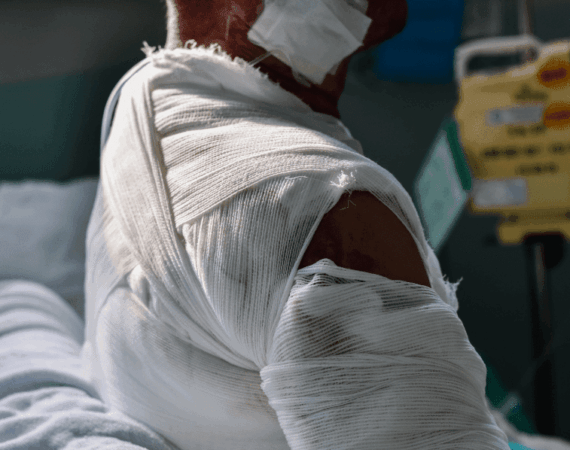 Burn injury victim with severe arm and shoulder burns wrapped in bandages in a Texas hospital.