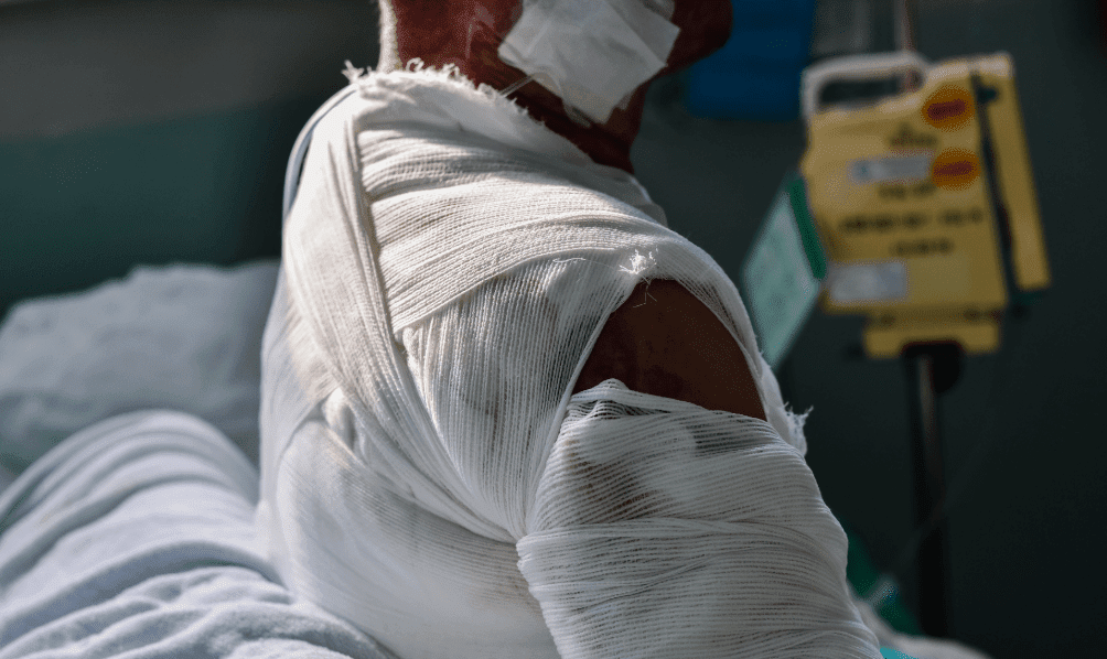 Burn injury victim with severe arm and shoulder burns wrapped in bandages in a Texas hospital.